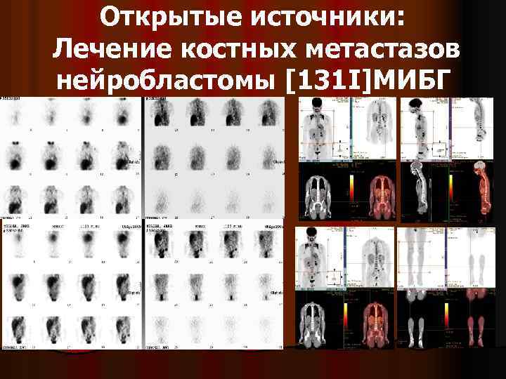 Открытые источники: Лечение костных метастазов нейробластомы [131 I]МИБГ 