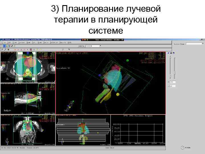3) Планирование лучевой терапии в планирующей системе 