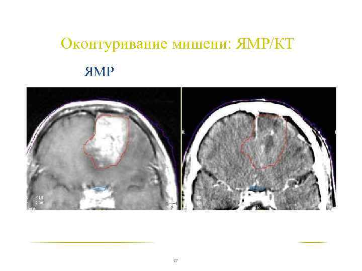 Оконтуривание мишени: ЯМР/КT ЯМР 27 