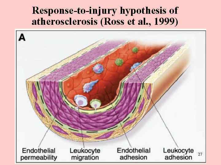 Response-to-injury hypothesis of atherosclerosis (Ross et al. , 1999) 27 