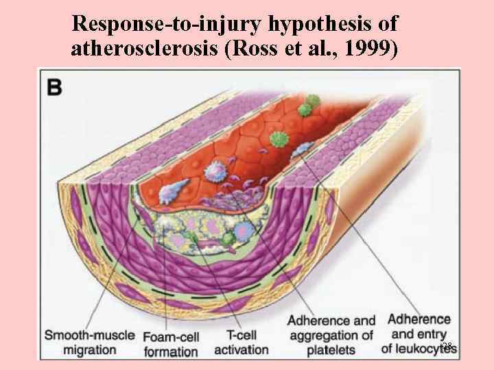 Response-to-injury hypothesis of atherosclerosis (Ross et al. , 1999) 28 