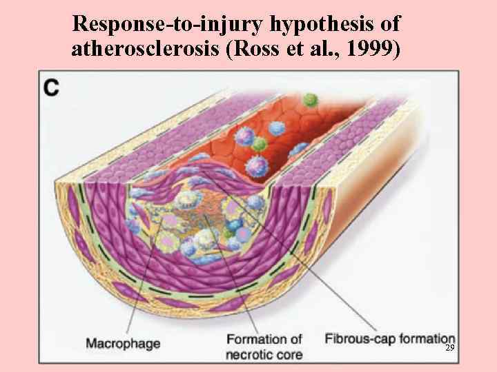 Response-to-injury hypothesis of atherosclerosis (Ross et al. , 1999) 29 