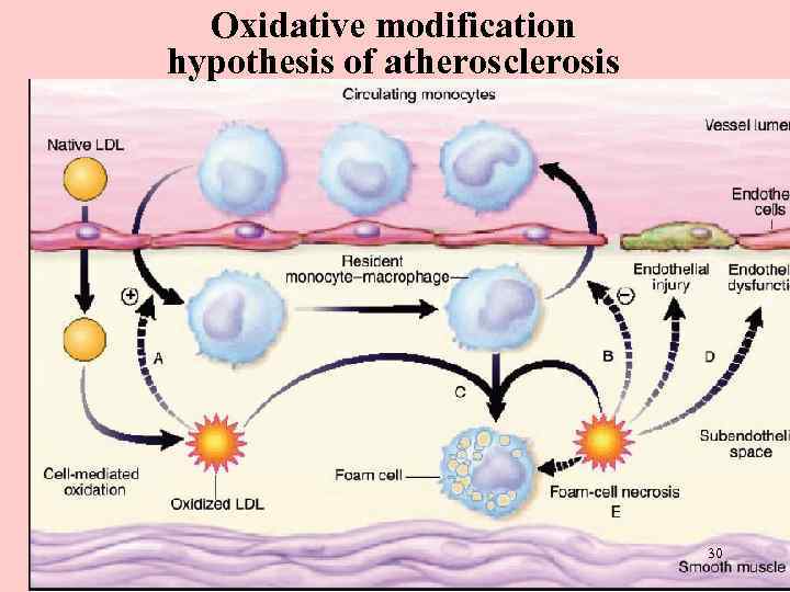 Oxidative modification hypothesis of atherosclerosis 30 