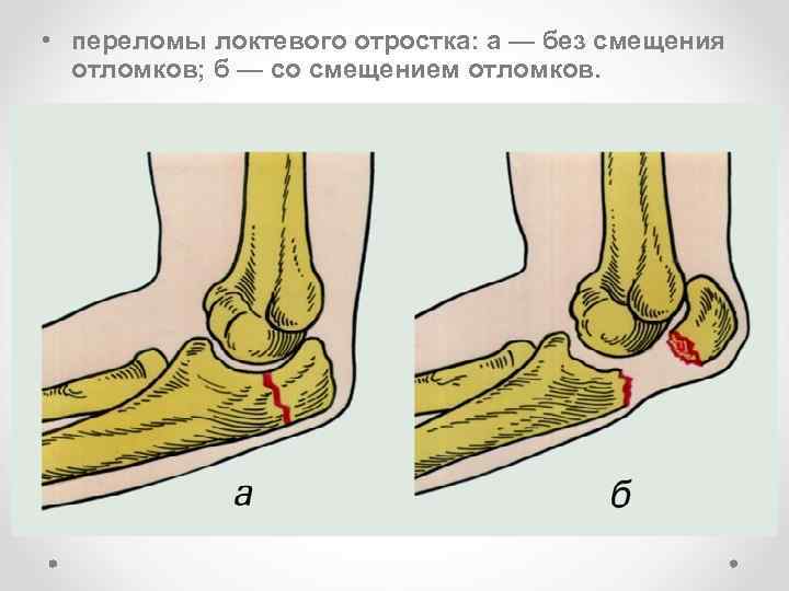 Перелом локтевой кости карта вызова