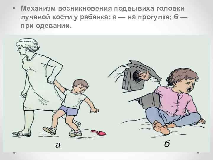  • Механизм возникновения подвывиха головки лучевой кости у ребенка: а — на прогулке;