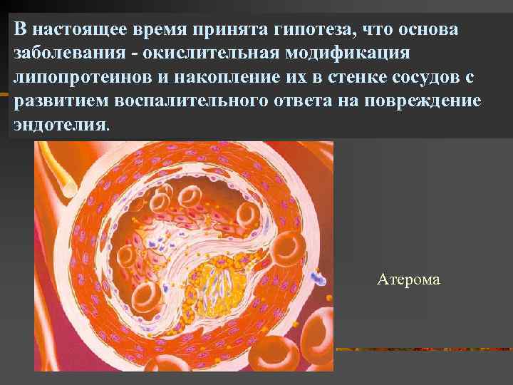 В настоящее время принята гипотеза, что основа заболевания - окислительная модификация липопротеинов и накопление