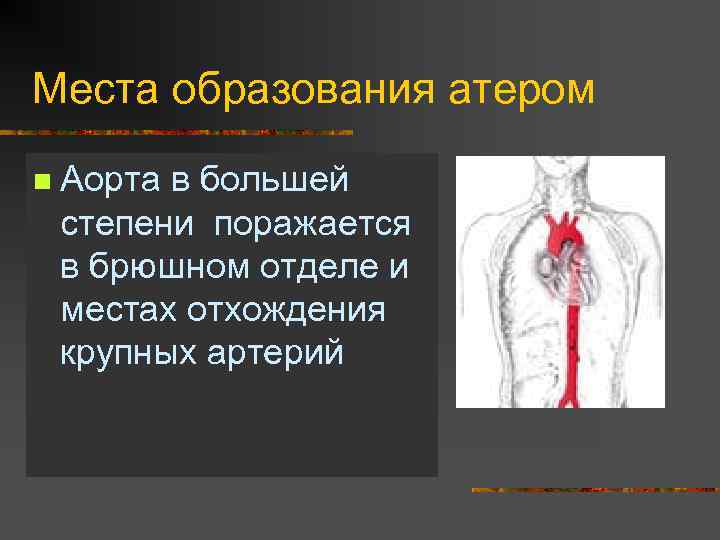 Места образования атером n Аорта в большей степени поражается в брюшном отделе и местах