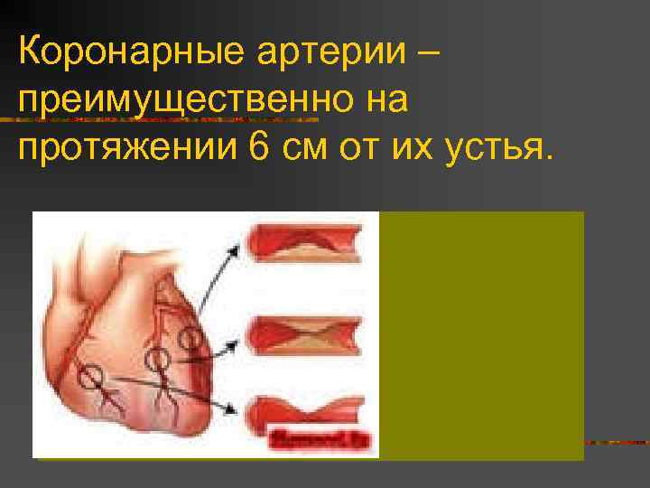 Коронарные артерии – преимущественно на протяжении 6 см от их устья. 