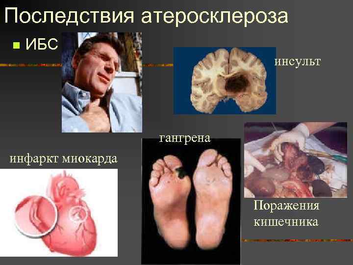 Последствия атеросклероза n ИБС инсульт гангрена инфаркт миокарда Поражения кишечника 