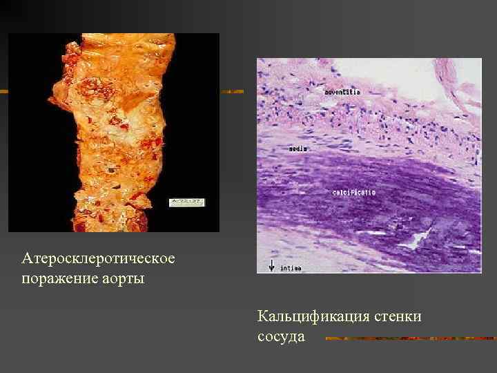 Атеросклеротическое поражение аорты Кальцификация стенки сосуда 