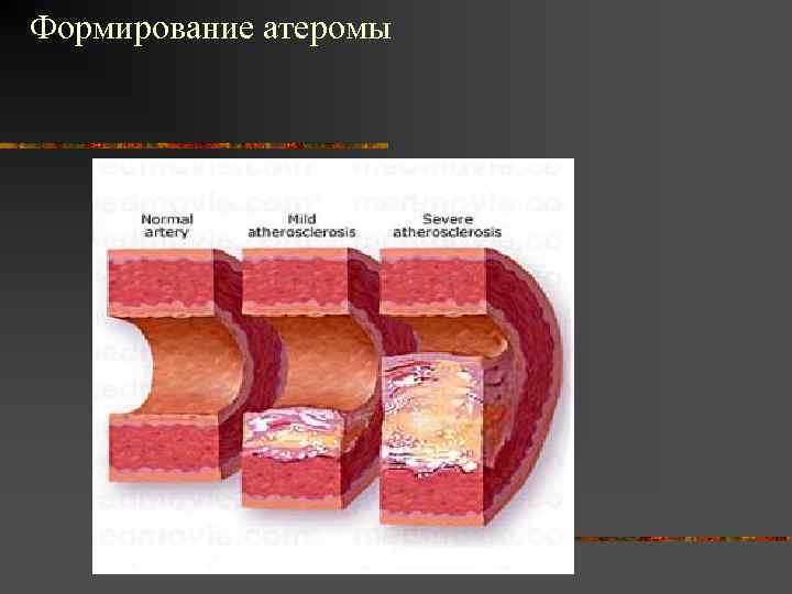 Формирование атеромы 