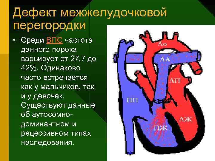 Дефект межжелудочковой перегородки • Среди ВПС частота данного порока варьирует от 27, 7 до