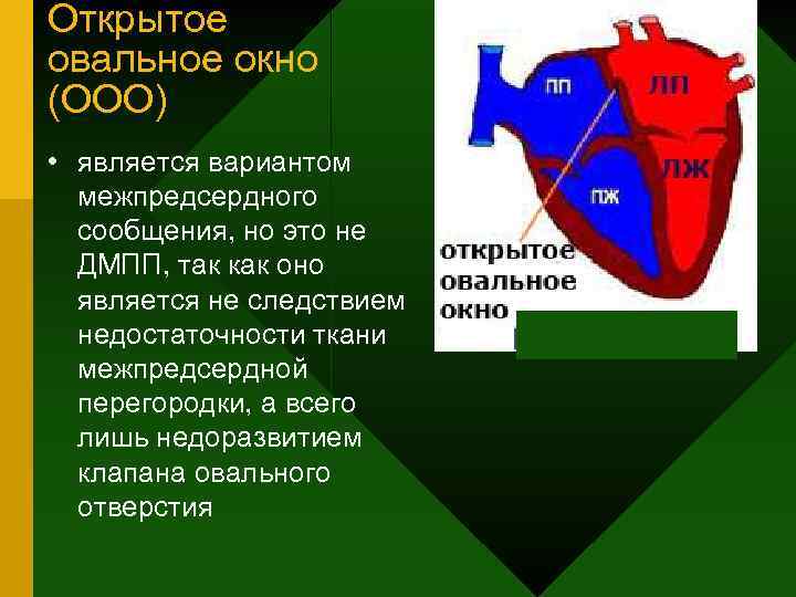 Открытое овальное окно (ООО) • является вариантом межпредсердного сообщения, но это не ДМПП, так