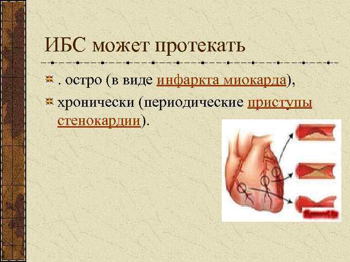 ИБС может протекать. остро (в виде инфаркта миокарда), хронически (периодические приступы стенокардии). 