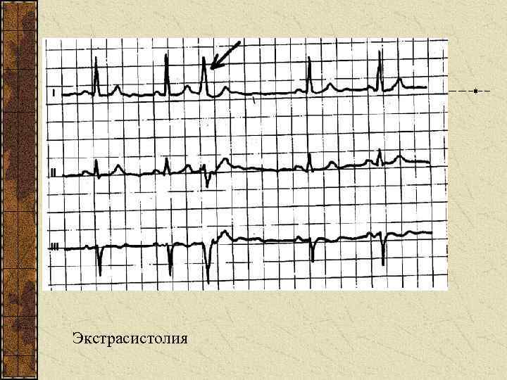 Экстрасистолия 