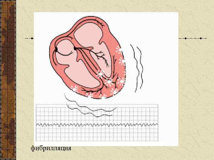 фибрилляция 