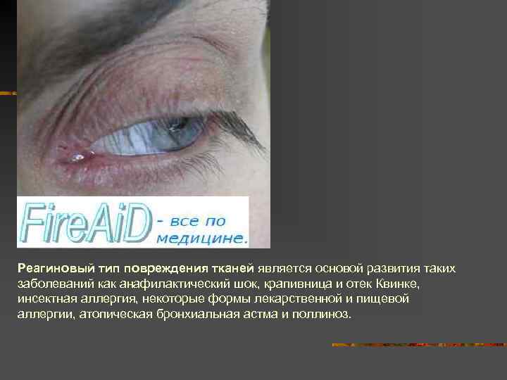 Реагиновый тип повреждения тканей является основой развития таких заболеваний как анафилактический шок, крапивница и