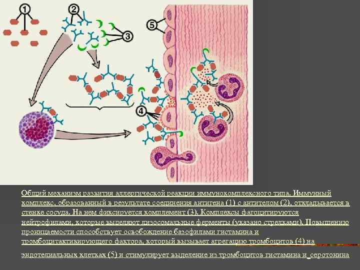 Общий механизм развития аллергической реакции иммунокомплексного типа. Иммунный комплекс, образованный в результате соединения антигена
