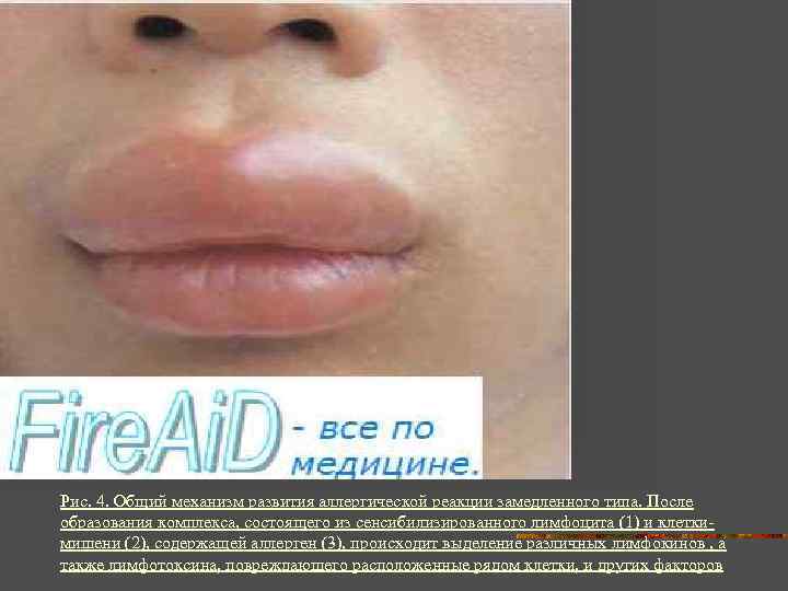 Рис. 4. Общий механизм развития аллергической реакции замедленного типа. После образования комплекса, состоящего из