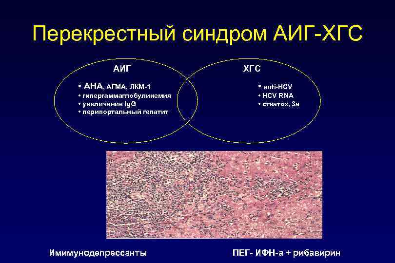 Перекрестный синдром АИГ-ХГС АИГ ХГС • АНА, АГМА, ЛКМ-1 • anti-HCV • гипергаммаглобулинемия •