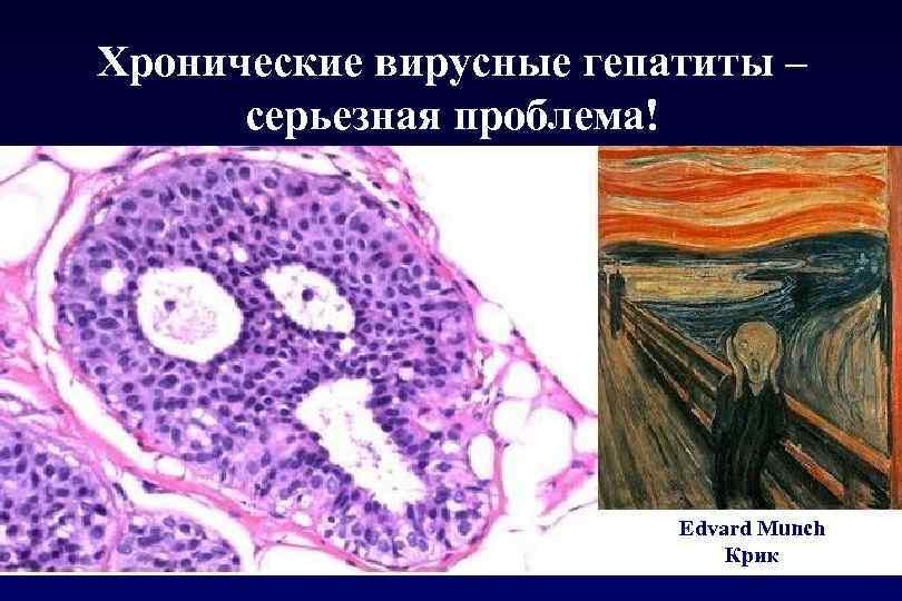 Хронические вирусные гепатиты – серьезная проблема! Edvard Munch Крик 