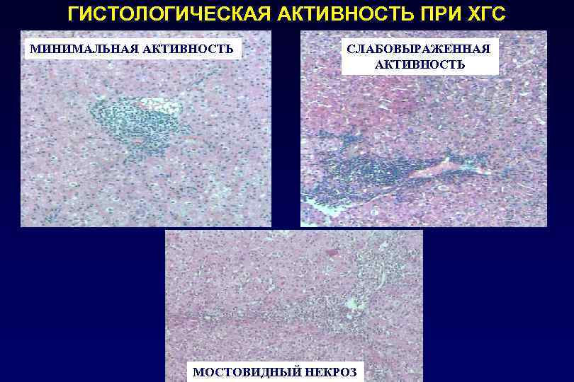 ГИСТОЛОГИЧЕСКАЯ АКТИВНОСТЬ ПРИ ХГС МИНИМАЛЬНАЯ АКТИВНОСТЬ СЛАБОВЫРАЖЕННАЯ АКТИВНОСТЬ МОСТОВИДНЫЙ НЕКРОЗ 