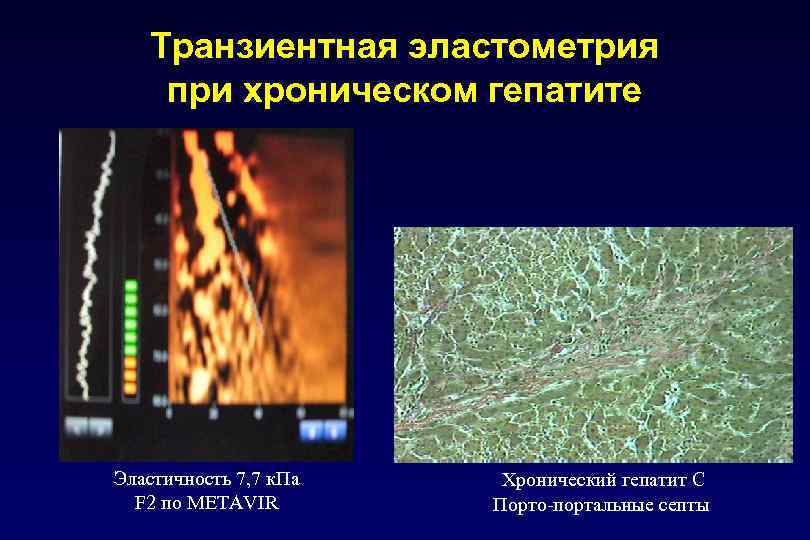 Транзиентная эластометрия при хроническом гепатите Эластичность 7, 7 к. Па F 2 по METAVIR