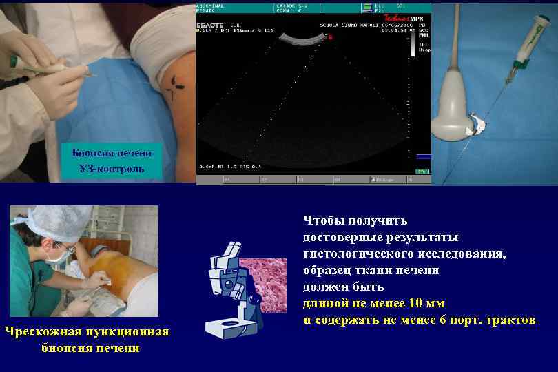 Биопсия печени УЗ-контроль Чрескожная пункционная биопсия печени Чтобы получить достоверные результаты гистологического исследования, образец