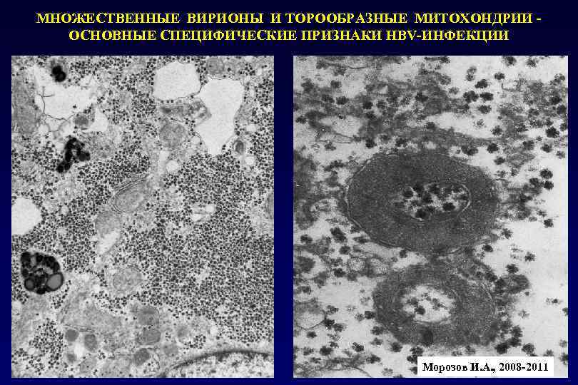 МНОЖЕСТВЕННЫЕ ВИРИОНЫ И ТОРООБРАЗНЫЕ МИТОХОНДРИИ - ОСНОВНЫЕ СПЕЦИФИЧЕСКИЕ ПРИЗНАКИ HBV-ИНФЕКЦИИ Морозов И. А. ,