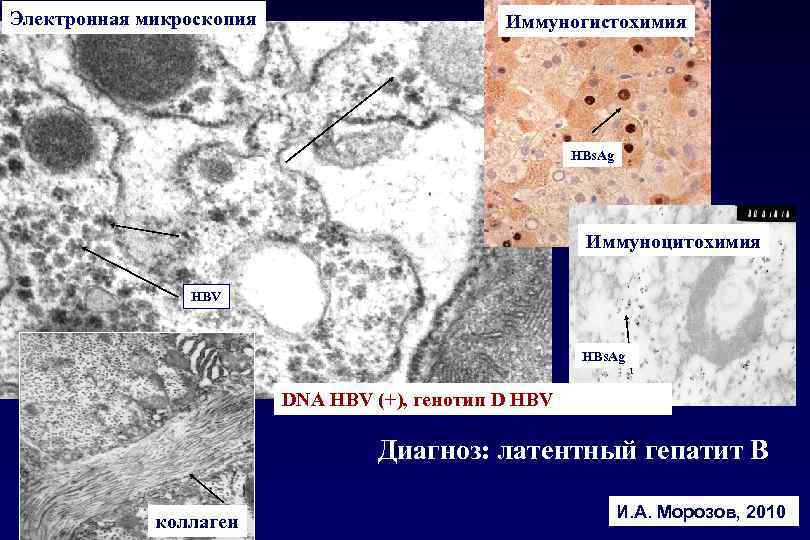 Электронная микроскопия Иммуногистохимия HBs. Ag Иммуноцитохимия HBV HBs. Ag DNA HBV (+), генотип D