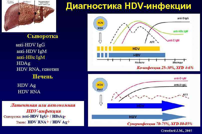 Диагностика HDV-инфекции Сыворотка anti-HDV Ig. G anti-HDV Ig. M anti-HBc Ig. M HDAg HDV