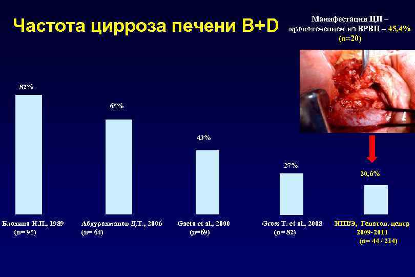 Частота цирроза печени В+D Манифестация ЦП – кровотечением из ВРВП – 45, 4% (n=20)