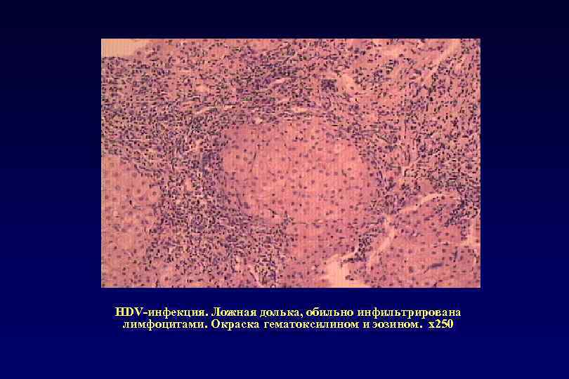 HDV-инфекция. Ложная долька, обильно инфильтрирована лимфоцитами. Окраска гематоксилином и эозином. х250 