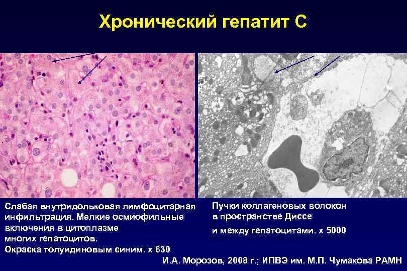 Хронический гепатит С Пучки коллагеновых волокон Слабая внутридольковая лимфоцитарная в пространстве Диссе инфильтрация. Мелкие