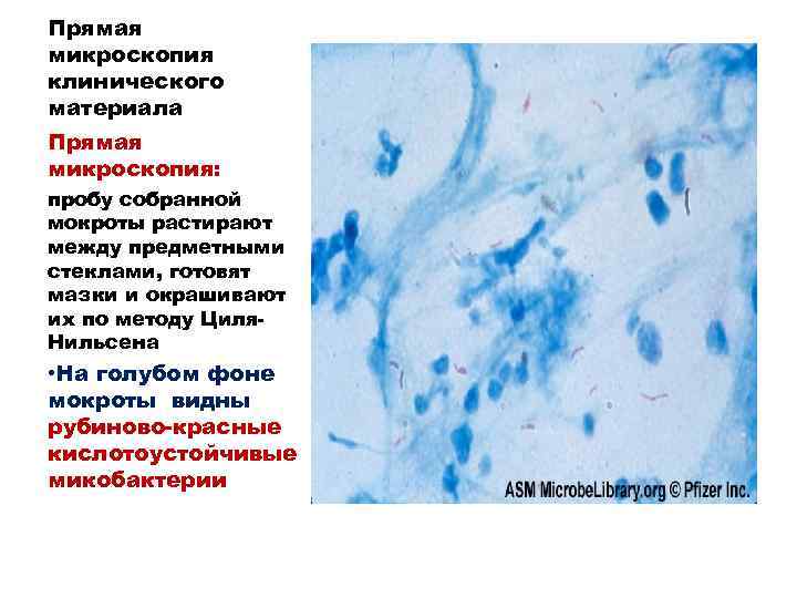 Исследование микроскопической картины мокроты