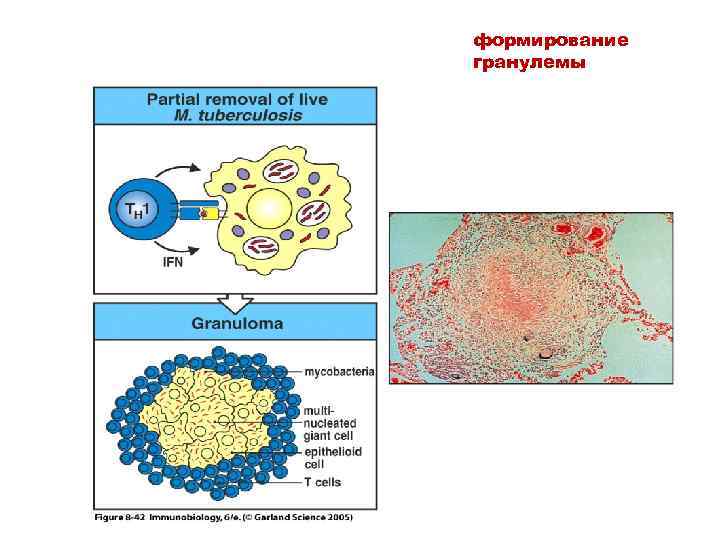 формирование гранулемы 