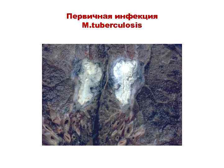 Первичная инфекция M. tuberculosis 