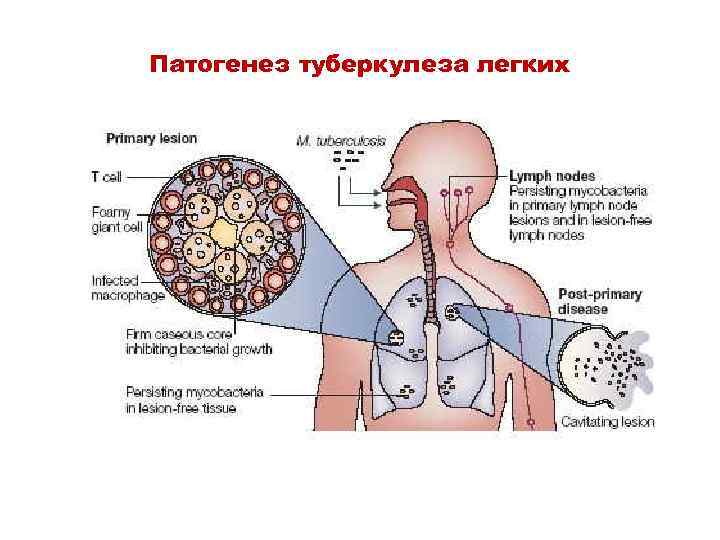 Патогенез туберкулеза легких 