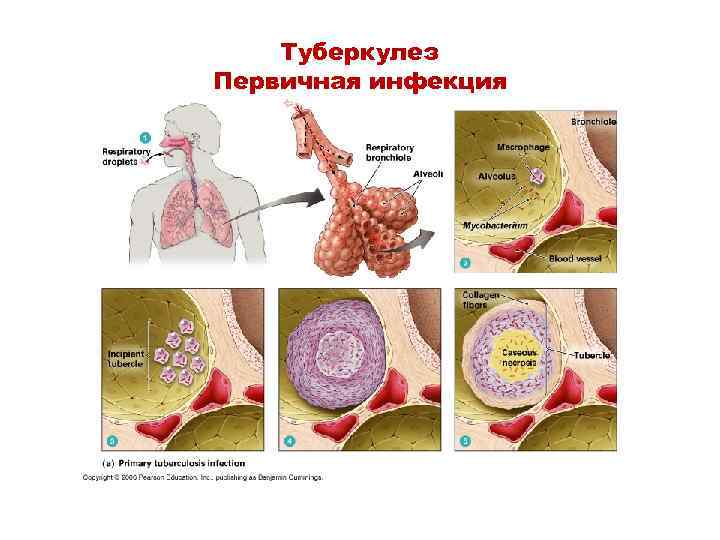 Туберкулез Первичная инфекция 