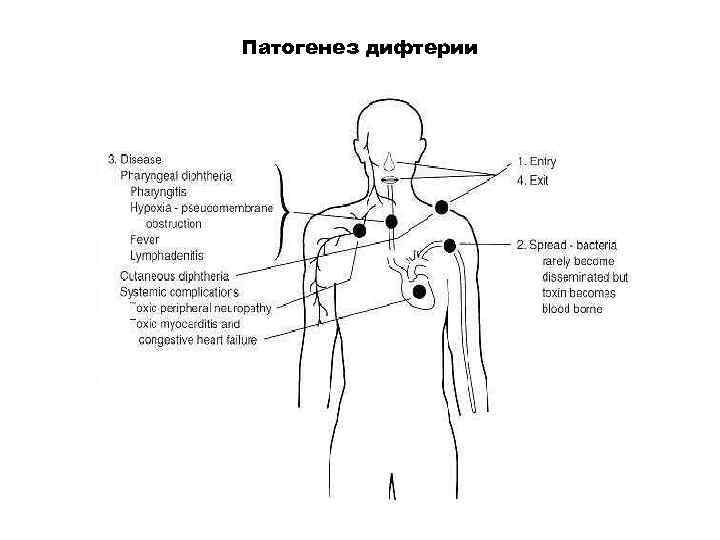 Патогенез дифтерии 