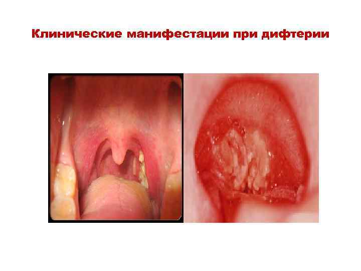 Клинические манифестации при дифтерии 