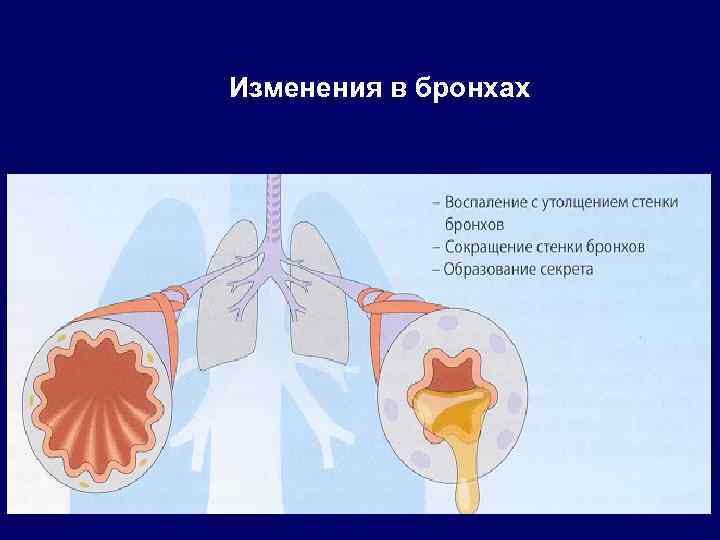 Изменения в бронхах 