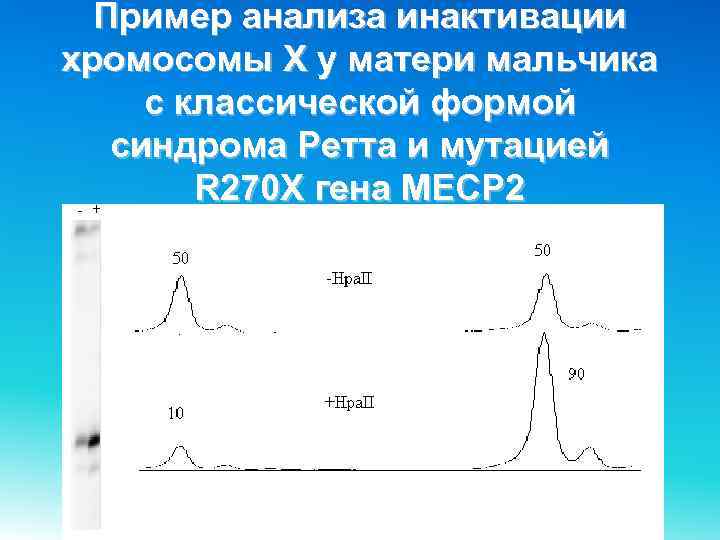 Пример анализа инактивации хромосомы Х у матери мальчика с классической формой синдрома Ретта и