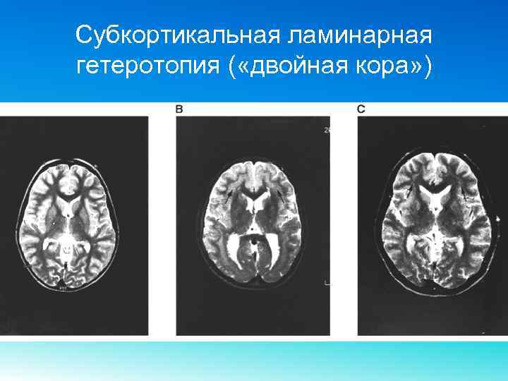 Субкортикальная ламинарная гетеротопия ( «двойная кора» ) 