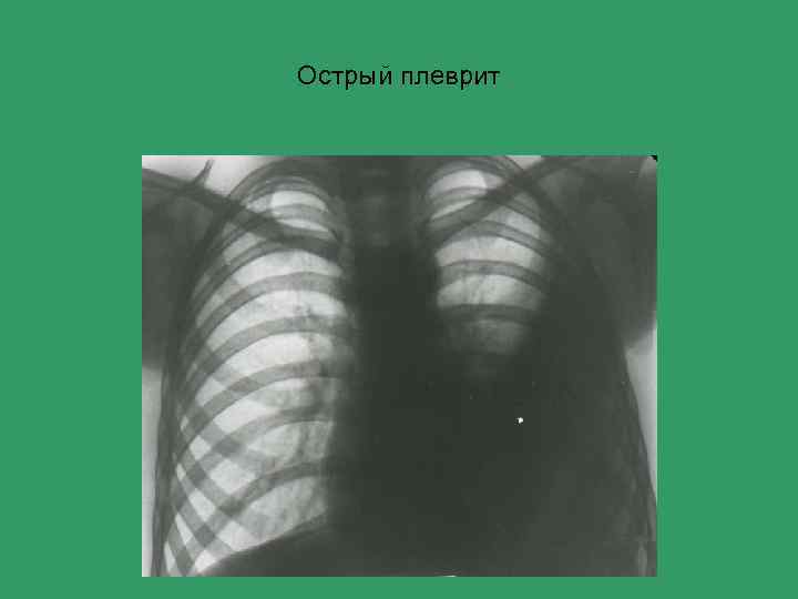 Острый плеврит 