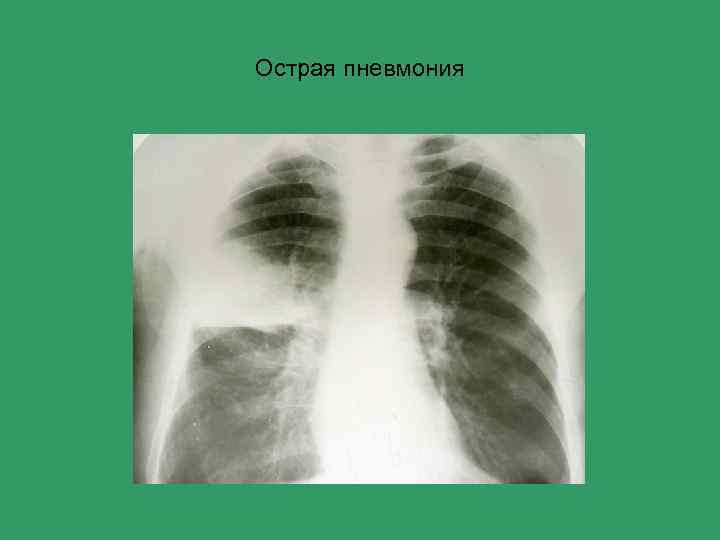 Острая пневмония 