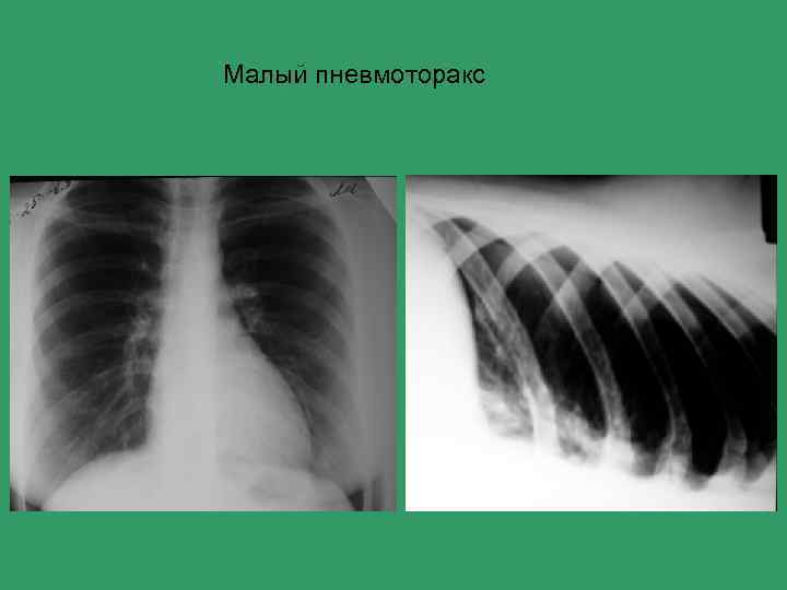 Малый пневмоторакс 