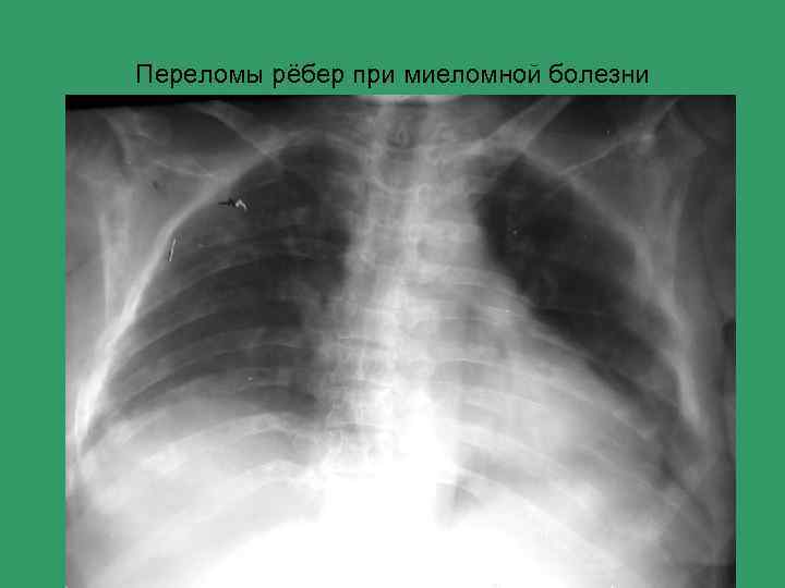 Переломы рёбер при миеломной болезни 
