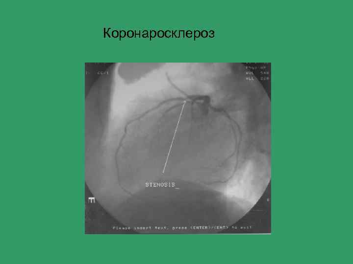 Коронаросклероз 