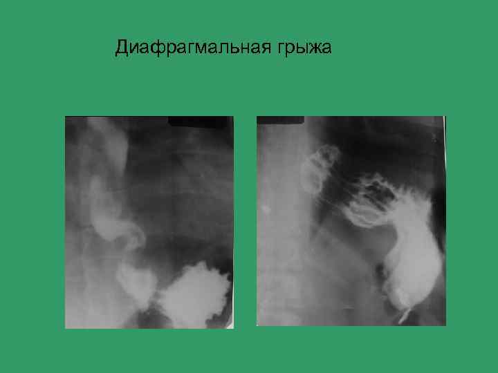Диафрагмальная грыжа 